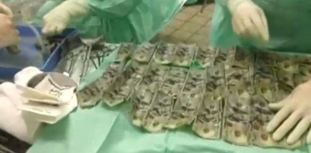 Kocasıyla Kavga Eden Kolombiyalı Kadın 7 Bin 500 Dolar Yuttu