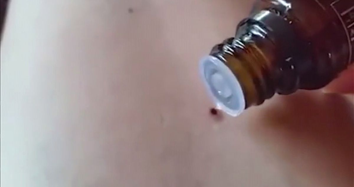 Genç Kadın Vücuduna Yapışan Keneyi Nane Yağıyla Söktü Attı