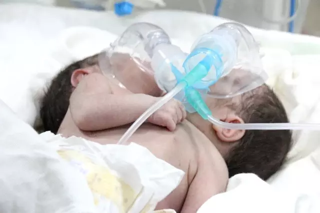 Suriye'de Doğan Çift Başlı Bebek, Türkiye'ye Getirildi