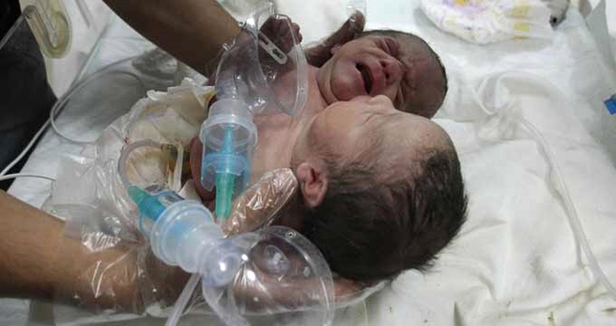 Suriye'de Doğan Çift Başlı Bebek, Türkiye'ye Getirildi