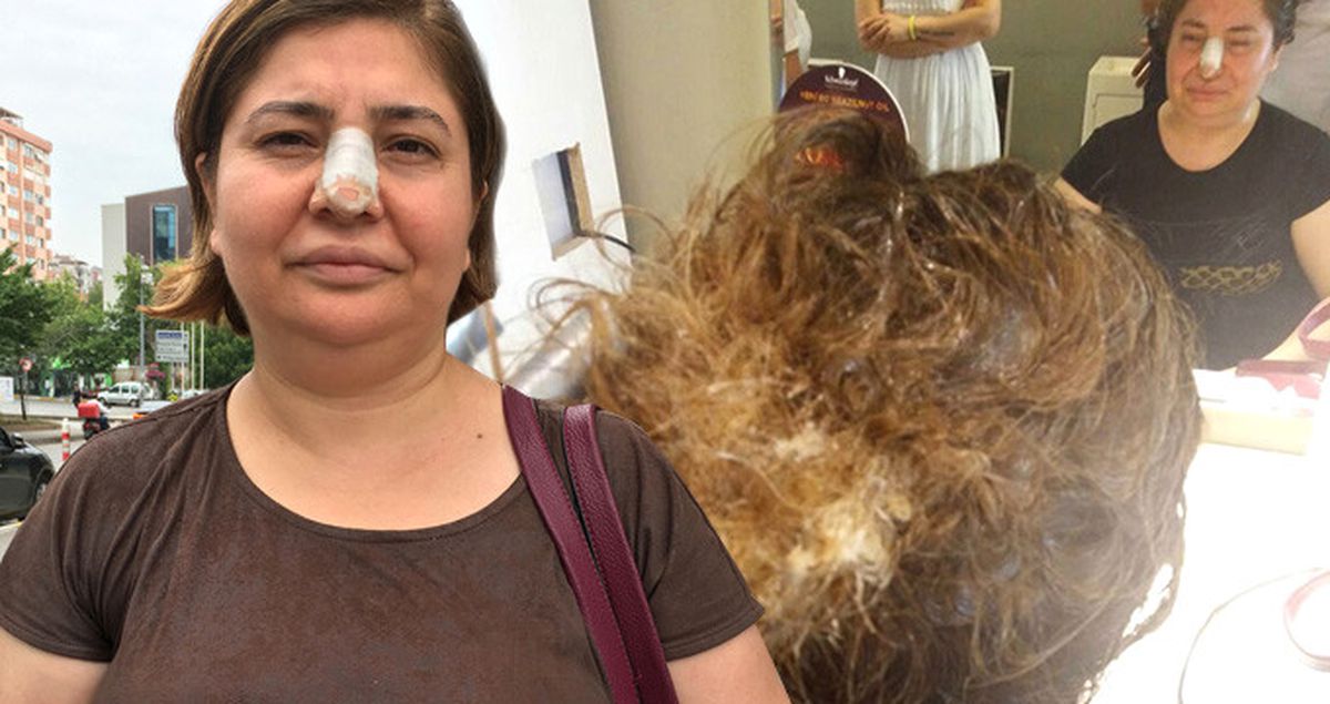 Kuaförde Saçlarını Yıkatan Talihsiz Kadın Kullanılan Kimyasal Nedeniyle Saçlarından Oldu