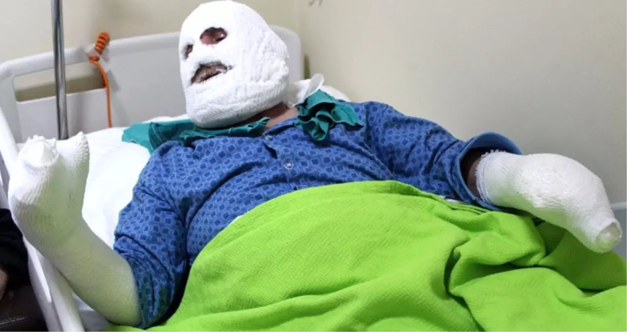 İşçilere Yemek Isıtan Aşçı, Odada Biriken Gazın Patlamasıyla Yanıklar İçinde Kaldı