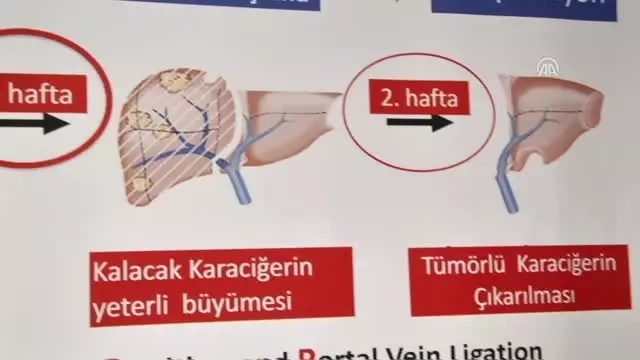 Karaciğer Kanseri Hastalarına Yeni Yöntem Umut Oldu Karaciğer Kanseri Hastalarına Yeni Yöntem Umut Oldu