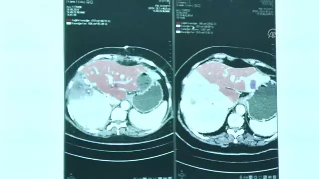 Karaciğer Kanseri Hastalarına Yeni Yöntem Umut Oldu Karaciğer Kanseri Hastalarına Yeni Yöntem Umut Oldu