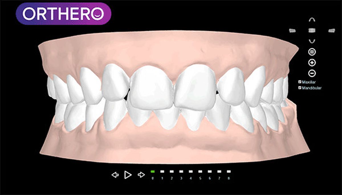 Şeffaf Aparey Orthero, Türkiye'de 3d Yazıcı ile Üretilen İlk ve Tek