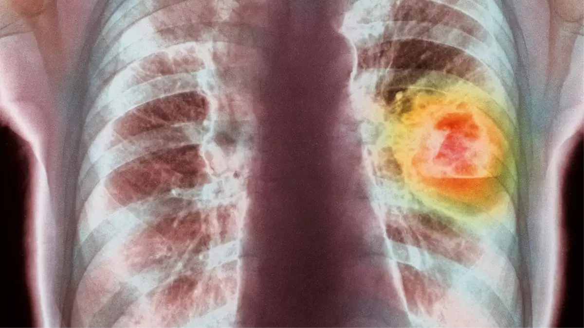 İskoçya'da Yapılan Araştırma: 'Altın Zerrecikleri Kanser İlaçlarının Etkisini Artırabilir'