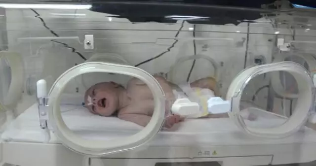 Yeni Doğan Bebeğin Karnından 1 Kilo 300 Gram Kitle Çıkarıldı