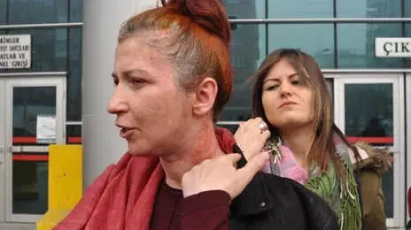 Sevgilisinin Yüzüne Kimyasal Madde Atan Zanlının, Tahliye Talebi Reddedildi
