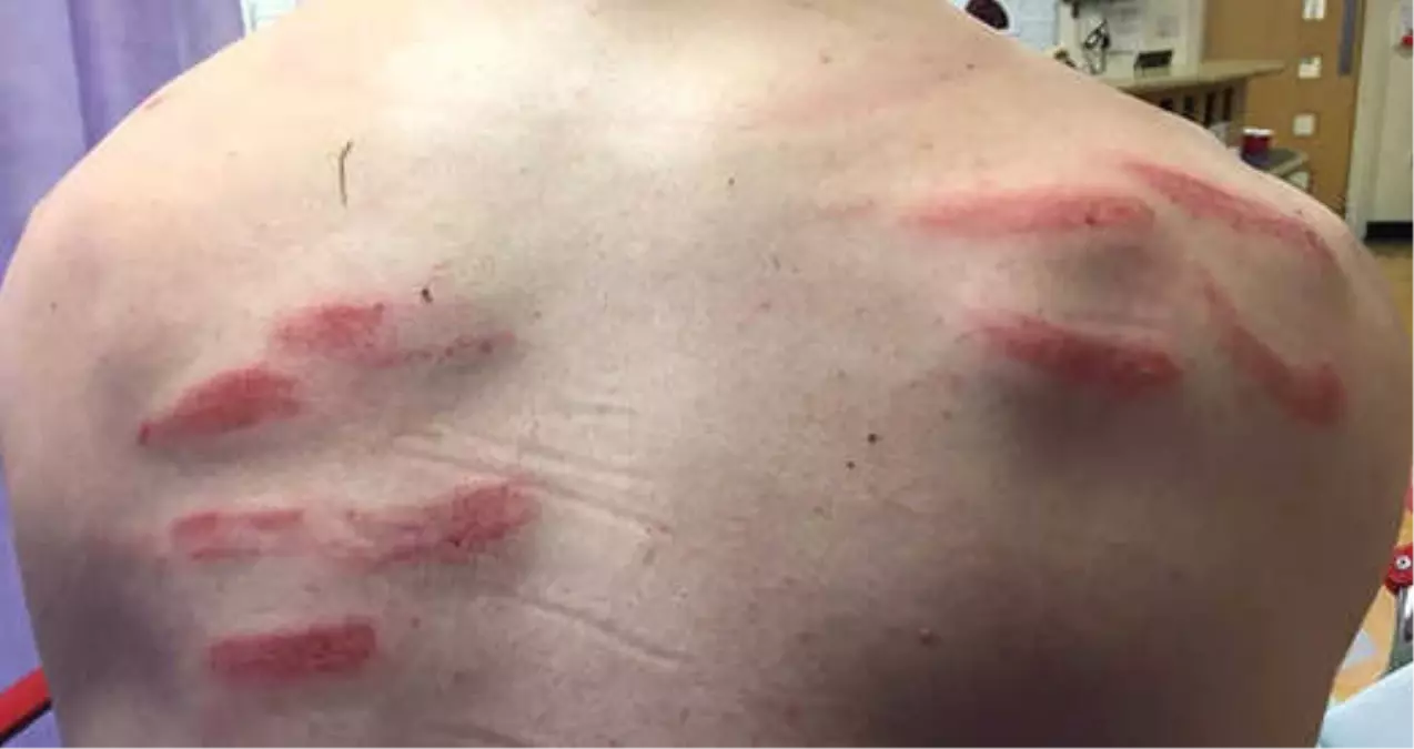 Sırtına Tekme Gelen Kaleci Hastanelik Oldu