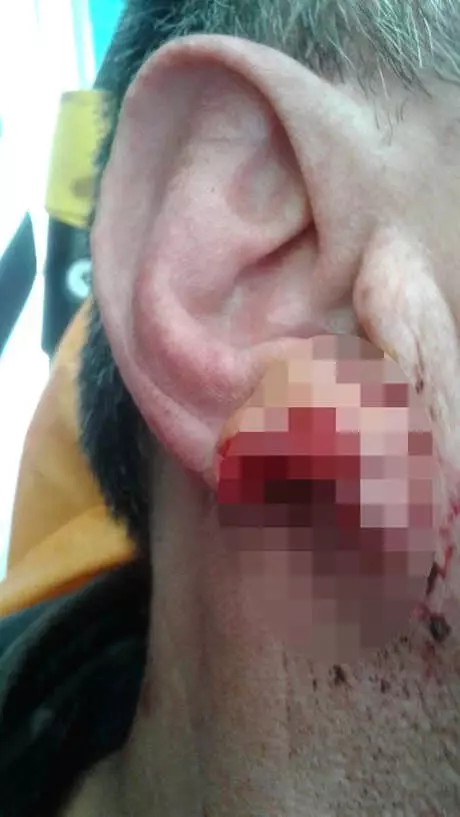 65 Bin liralık Alacağını İsteyince Kavga Çıktı, Talihsiz Adamın Kulağı Isırılarak Koparıldı 65 Bin liralık Alacağını İsteyince Kavga Çıktı, Talihsiz Adamın Kulağı Isırılarak Koparıldı