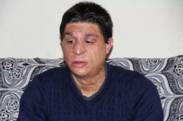 Yüzüne Gelen Meşale Hayatını Kararttı Yüzüne Gelen Meşale Hayatını Kararttı