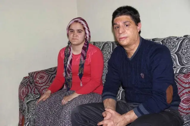 Yüzüne Gelen Meşale Hayatını Kararttı Yüzüne Gelen Meşale Hayatını Kararttı