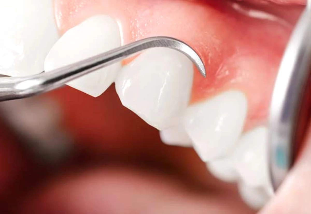 Diş Eti Hastalığının Sebebi Bu Kanser Türü Olabilir Haberler