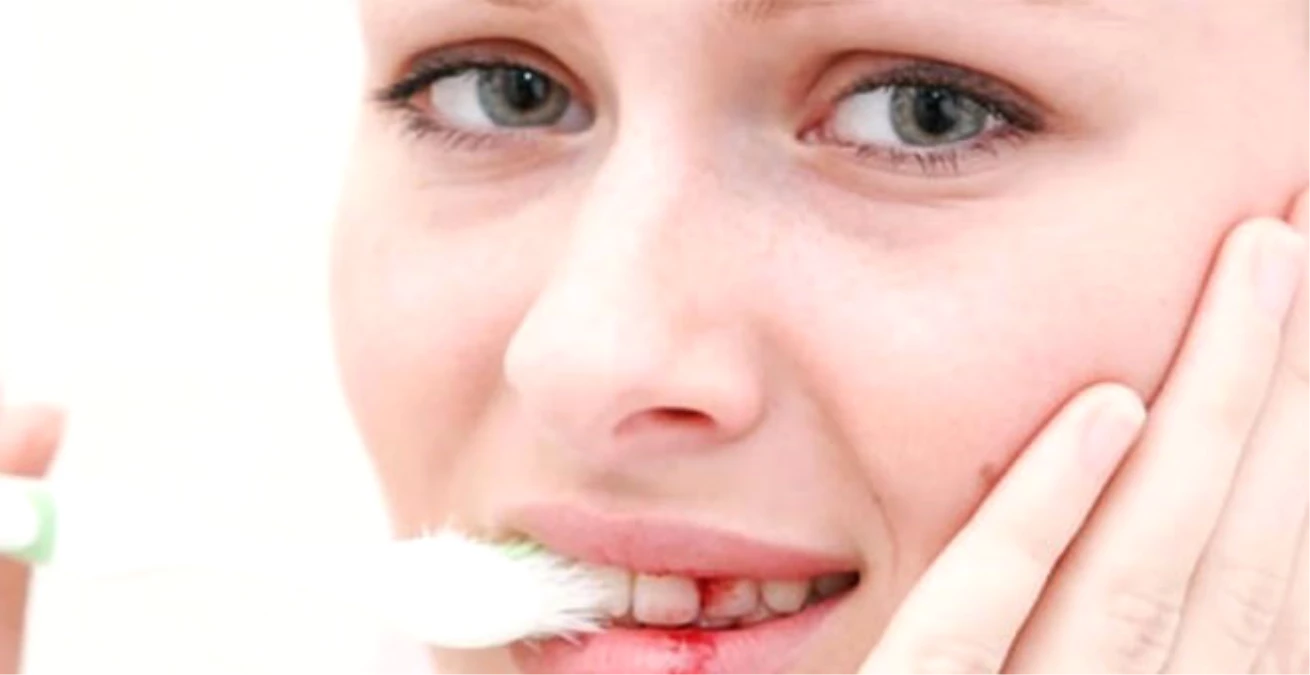 Diş Eti Kanaması Nasıl Tedavi Edilir? Haberler