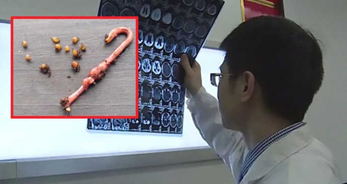 Az Pişmiş Domuz Eti Yiyen Adamın Beyninde 30 Tenya Yumurtası Bulundu