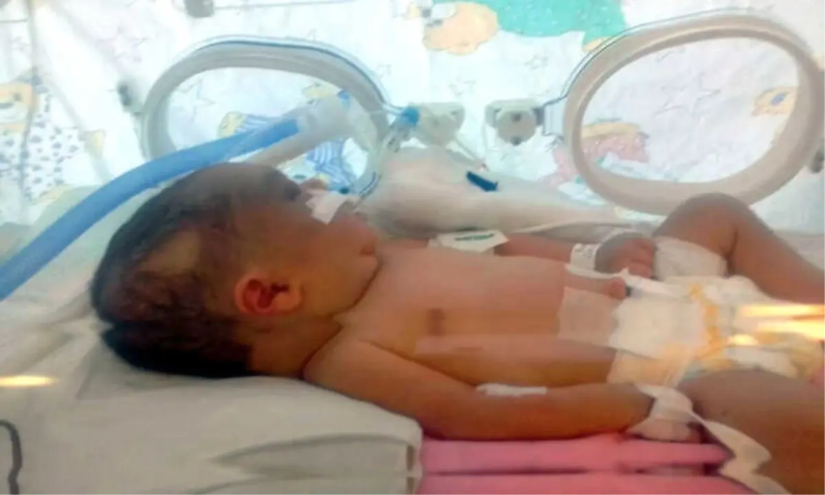 Kafatası Çatlayan 6 Günlük Bebek, Yaşam Savaşı Veriyor