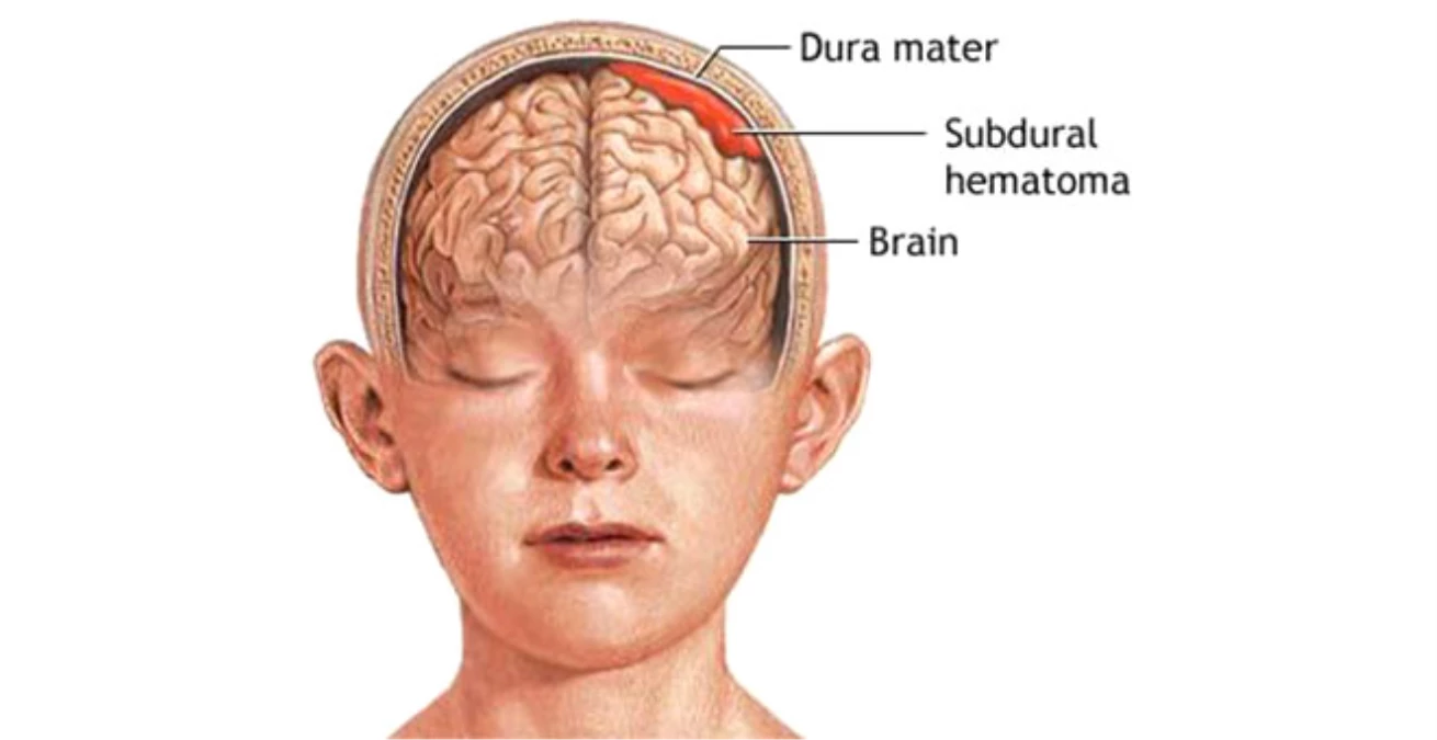 11 лба. Субдуральная гематома черепа. Тарвмв головы у ребенка. Травмы головного мозга у детей.