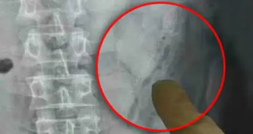 Sarhoş Olup Fenalaşan Çinli Hastaneye Kaldırıldı, İçinden 2 Tane Kedi Balığı Çıktı