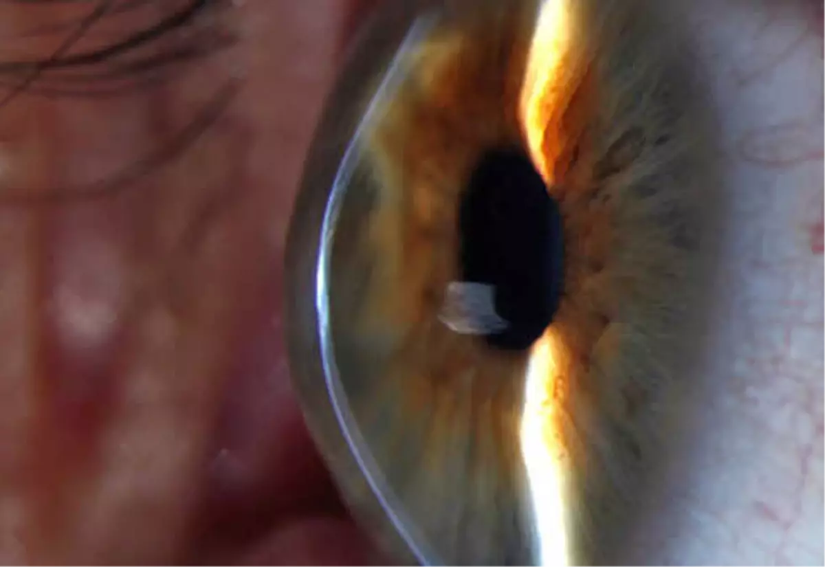 Gözlük Numaranız Hızlı Değişiyorsa Dikkat!