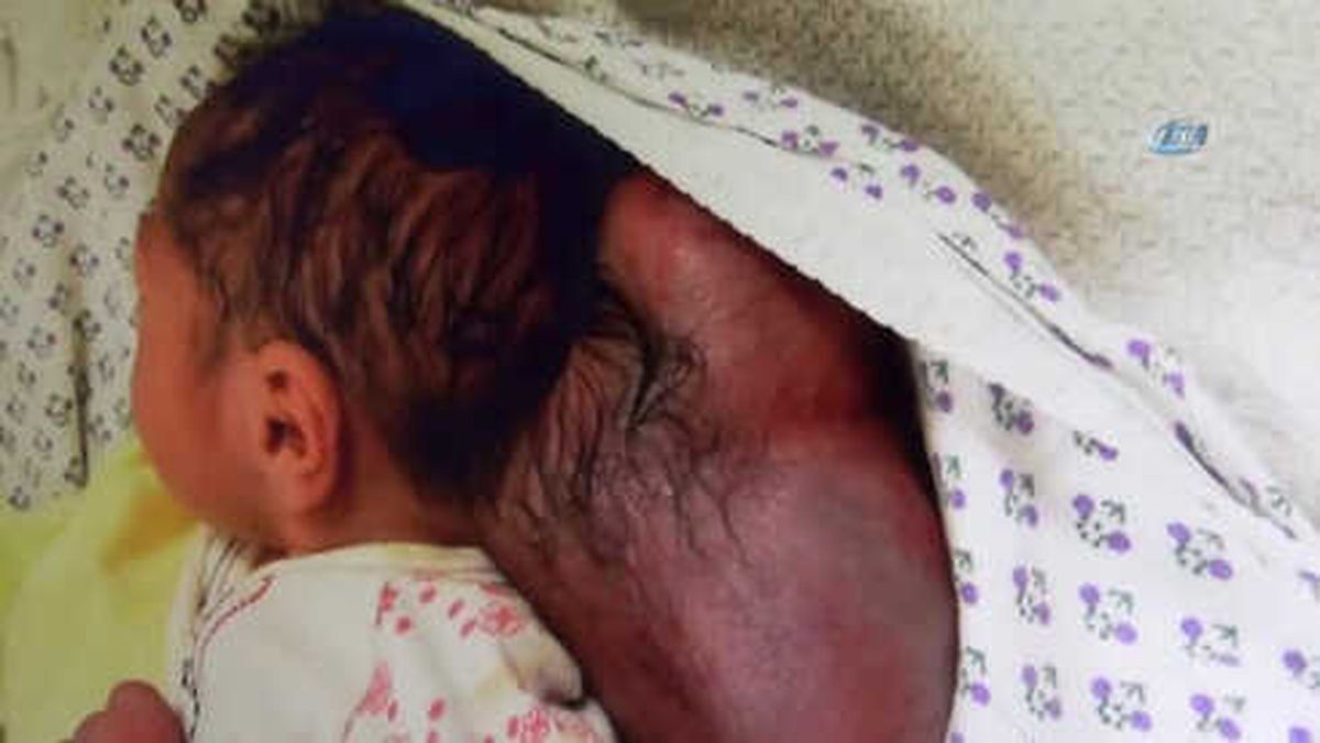Hatay'da İki Kafalı Bebek Dünyaya Geldi