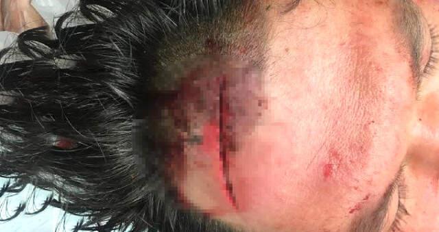 Öfkeli Baba, Çocuğun Ateşi Düşmeyince Doktorun Başında Parke Taşı Parçaladı