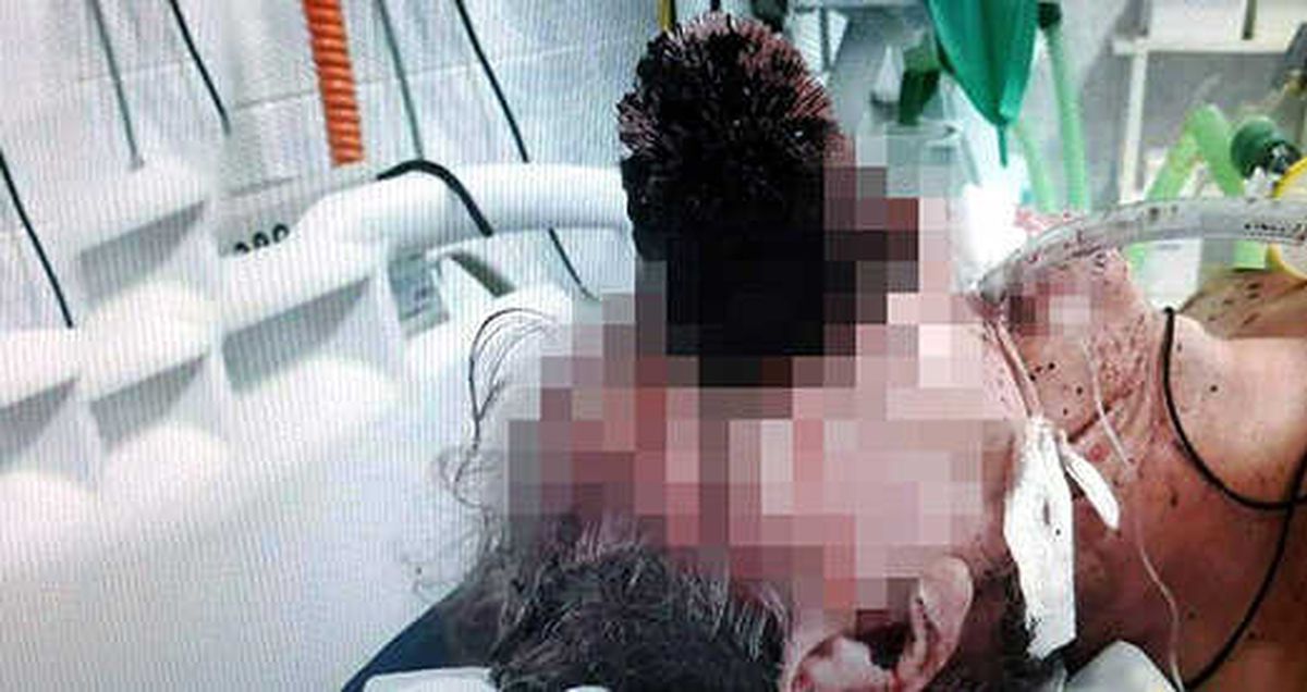 Lavaboda Ayağı Kayan Adamın Gözüne Tuvalet Fırçası Saplandı