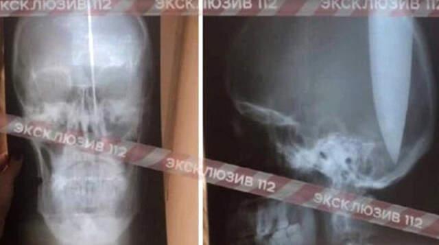 Rusya'da Burnu Tıkanan Adam, Nefes Almak İçin Bıçakla Başını Deldi