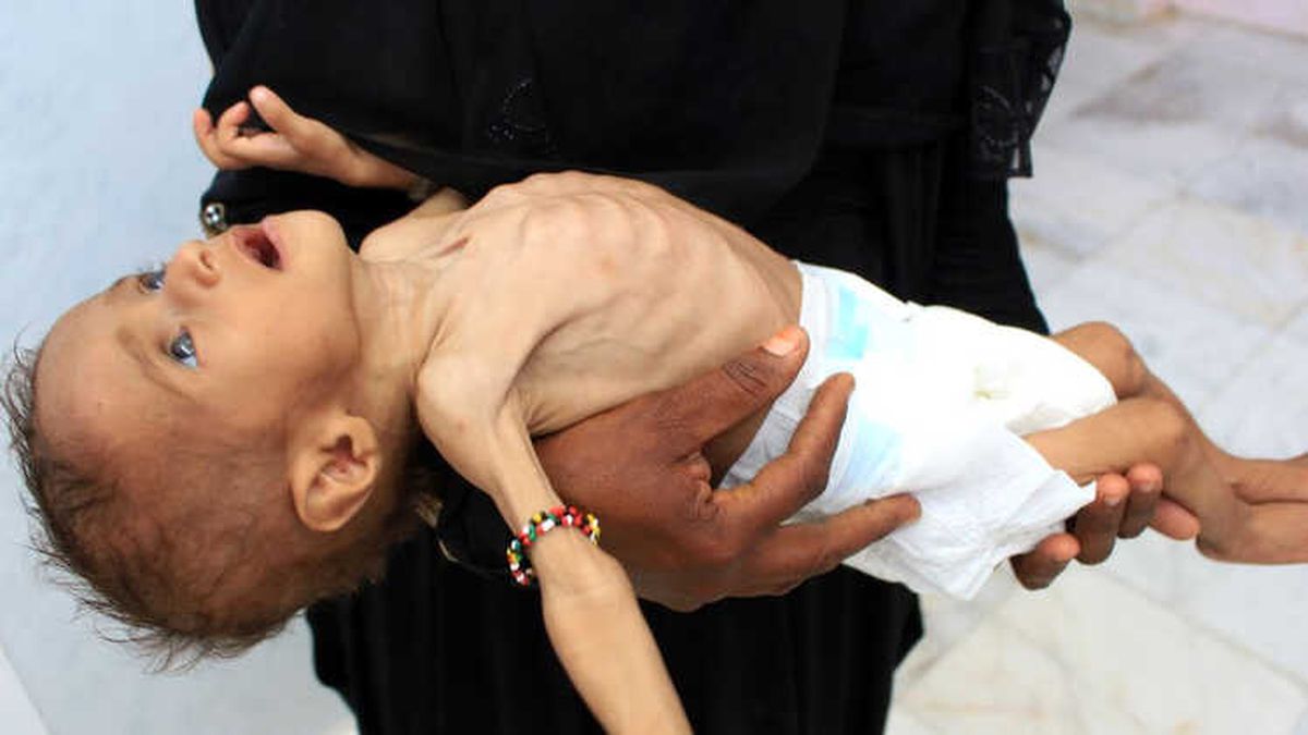 Yemen Krizi: '85 Bin Çocuk Açlıktan Öldü'