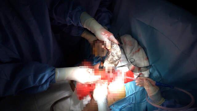 Rapunzel Hastası Minik Dua'nın Midesinden Çıkanlar Doktorları Bile Şaşırttı