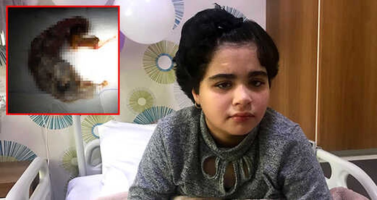 Rapunzel Hastası Minik Dua'nın Midesinden Çıkanlar Doktorları Bile Şaşırttı