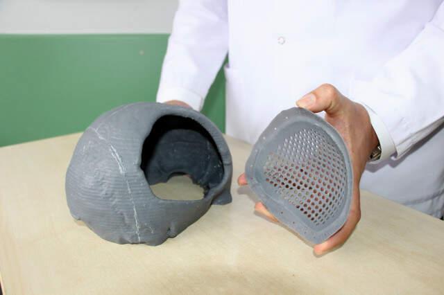 3D Yazıcı Tekniğiyle Kafasına Titanyum Parça Takılan Hastanın İnanılmaz Değişimi