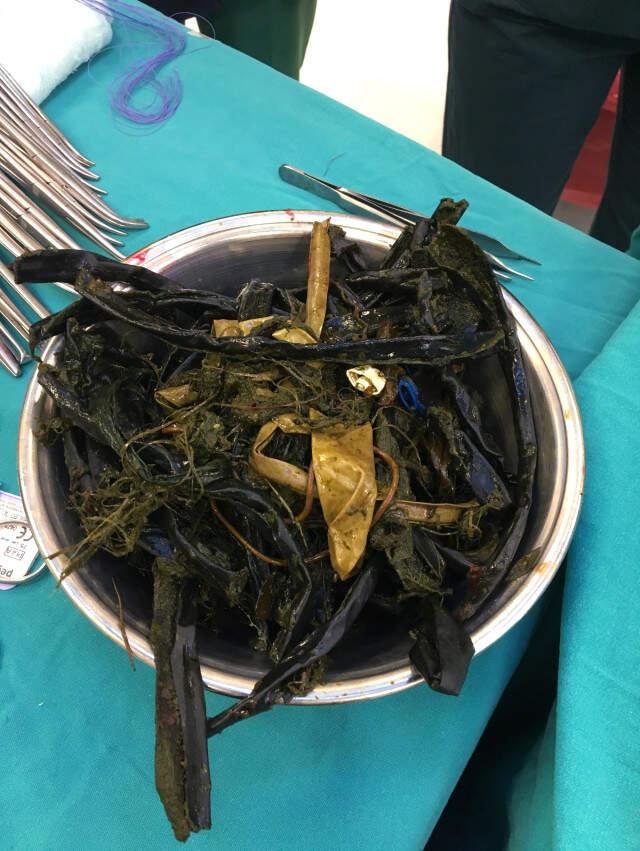 Otizmli Çocuğun Midesinden 2 Kiloluk Plastik Çay Kaşığı, Eldiven ve Kablo Çıktı!