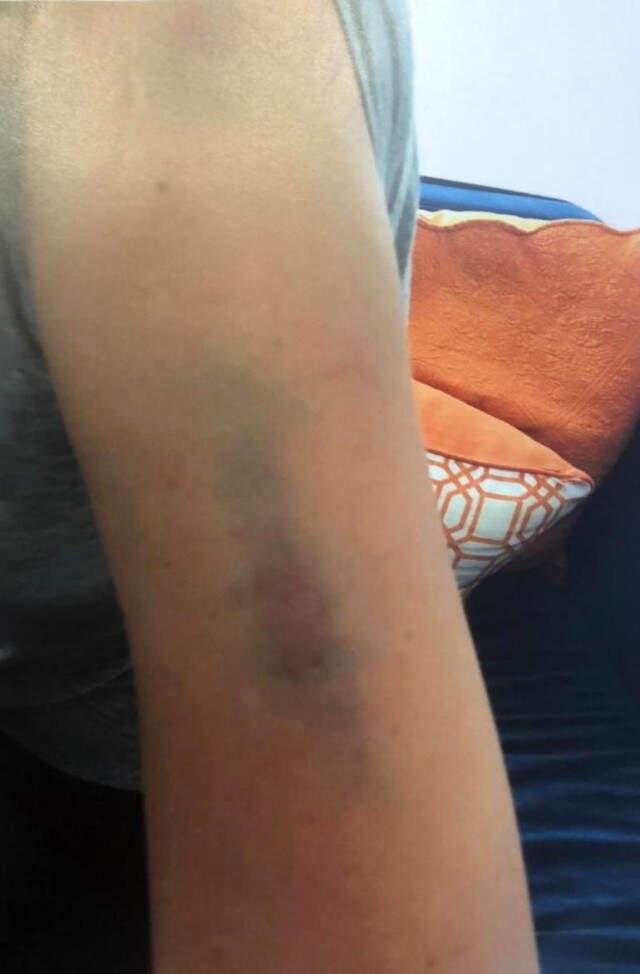 Adli Tıp, 'Sıla'nın Morlukları Gerçek Değil' İddialarını Yalanladı: Rapor Hazırlamadık