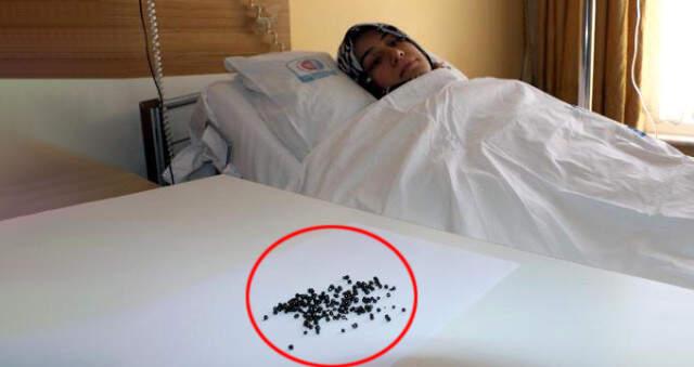 Karın Ağrısıyla Gittiği Hastanede Vücudundan 200 Adet Taş Çıkarıldı