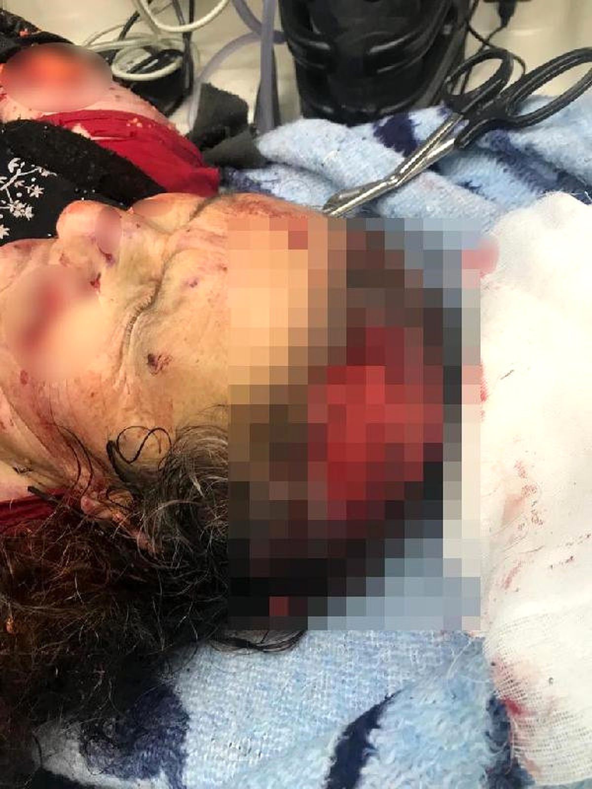 Kayseri'den Sonra Kırşehir'de de Sokak Köpeklerinin Saldırdığı Kadın Ağır Yaralandı