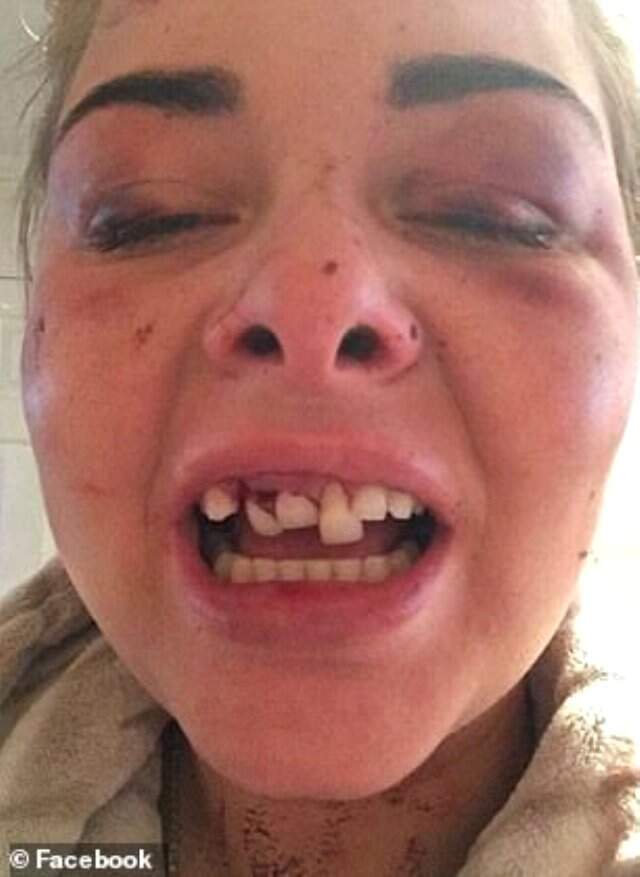 Genç Kadın, Eski Sevgilisiyle Birlikte Çektirdikleri Fotoğrafları Sosyal Medyadan Silince Ölesiye Dayak Yedi