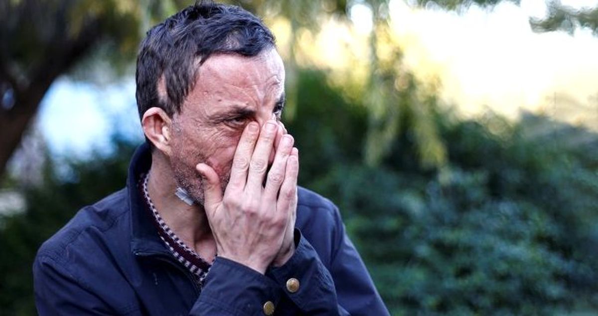 Türkiye'de İlk Yüz Nakli Yapılan Hastayı Gören, Şaşıp Kalıyor