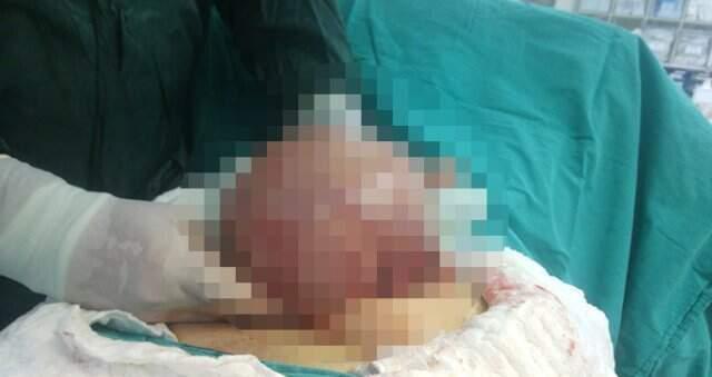Aşırı Kilo Problemi Nedeniyle Hastaneye Giden Kadının Midesinden 7 Kilo Ur Çıktı