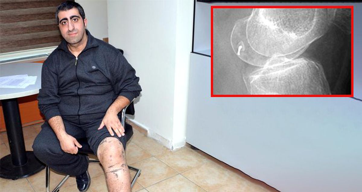 Hastanın Bacağında Tıbbi Kamera Parçası Unutup 'Bizimle İlgisi Yok' Dediler