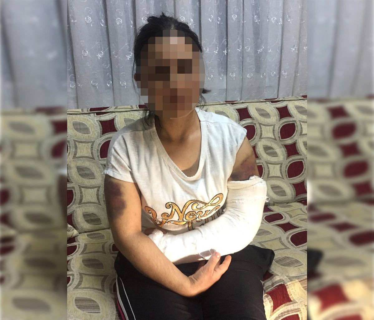Cani Kocası Tarafından İnşaat Demiriyle Dövülen Kadın 'Merdivenden Düştüm' Dedi