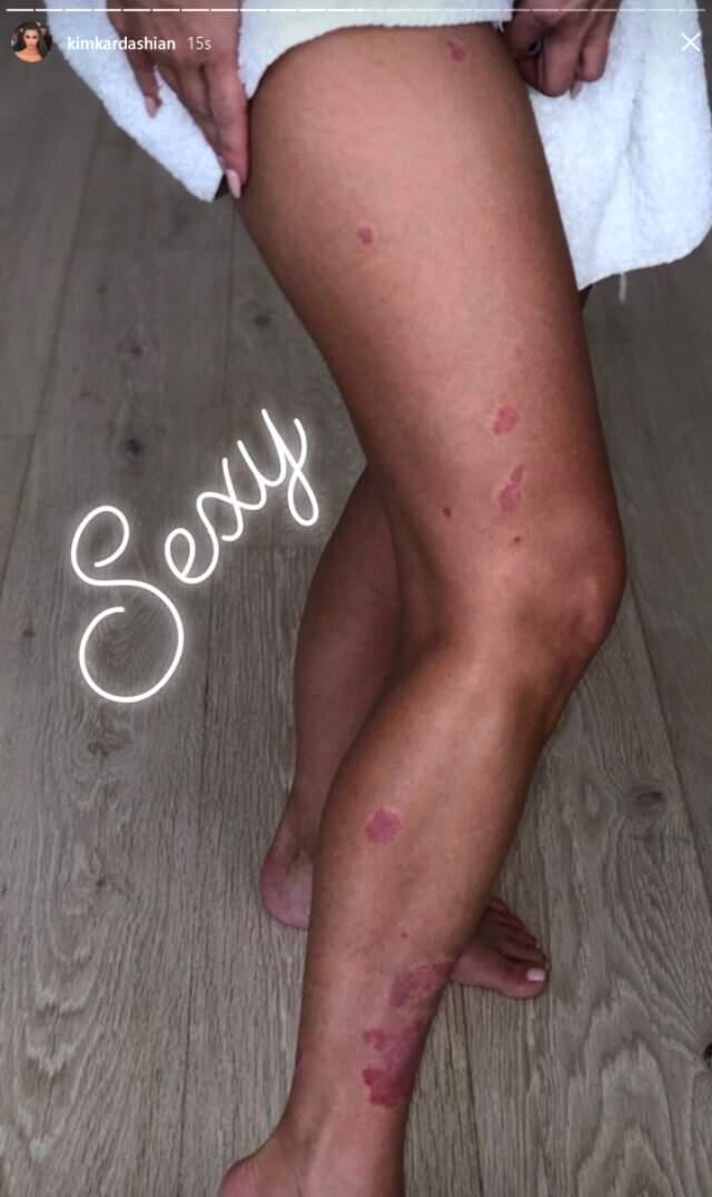 Sedef Hastası Olan Kim Kardashian, Paylaştığı Fotoğrafla Hayranlarını Korkuttu