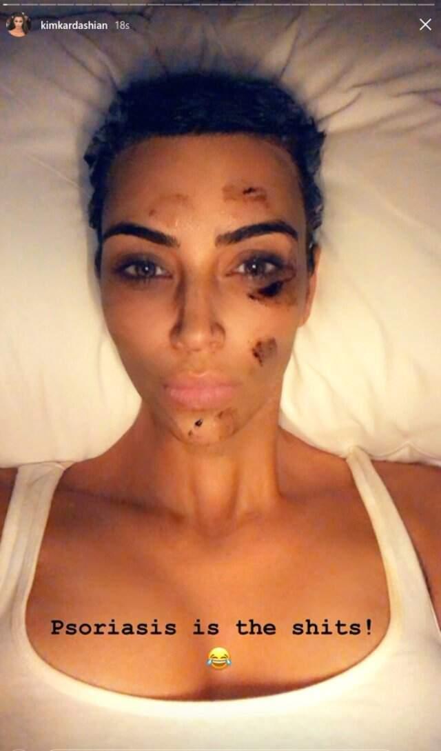 Sedef Hastası Olan Kim Kardashian, Paylaştığı Fotoğrafla Hayranlarını Korkuttu