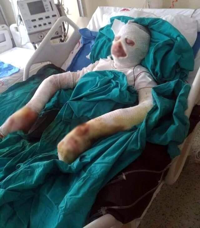 Liseli Öğrencisi Gözde, Bitlenen Saçlarını Benzinle Yıkamak İsterken Kendini Yaktı