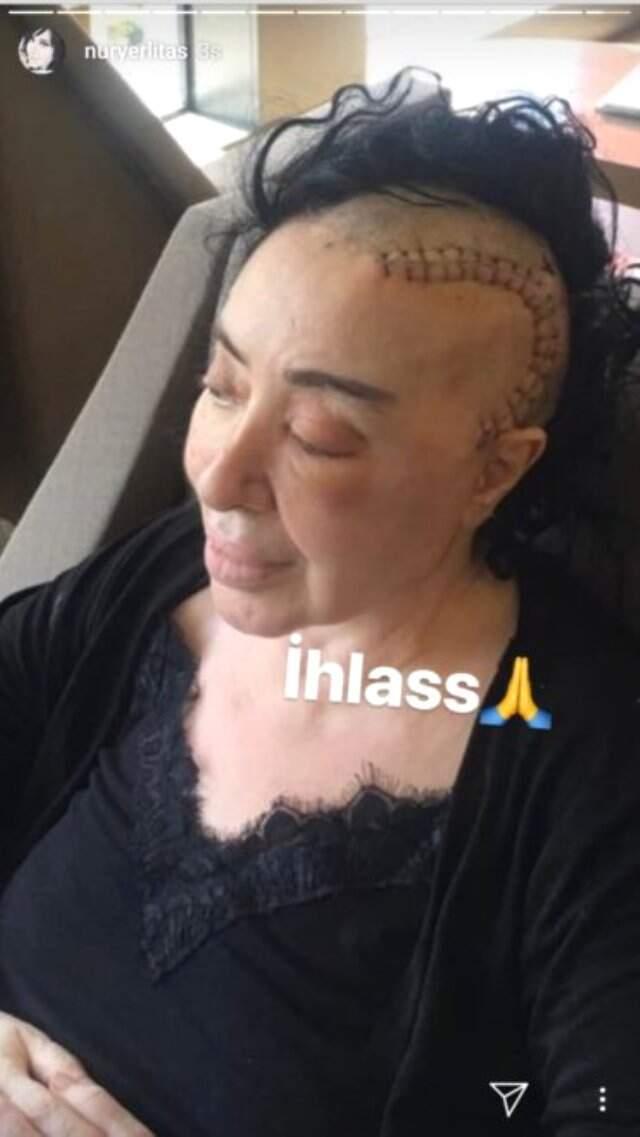 Nur Yerlitaş'tan Takipçilerini Kaygılandıran Sargılı Fotoğraf!