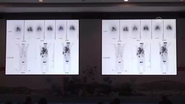 Stres ve Moral Bozukluğu Kanserin Büyümesini Tetikliyor Stres ve Moral Bozukluğu Kanserin Büyümesini Tetikliyor
