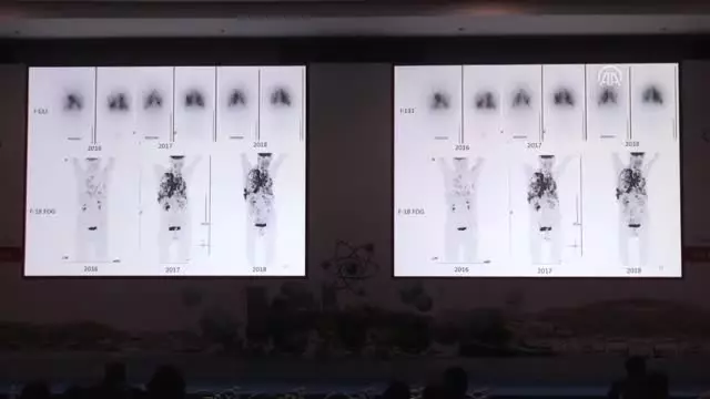 Stres ve Moral Bozukluğu Kanserin Büyümesini Tetikliyor Stres ve Moral Bozukluğu Kanserin Büyümesini Tetikliyor