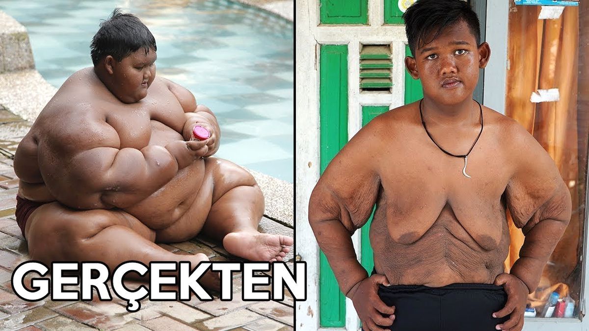 Dünyanın En Şişman Çocuğu 100 Kilo Verdi | Gerçekten