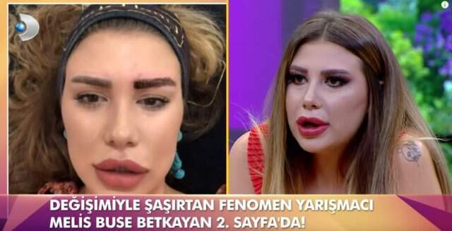 Melis Buse Betkayan, Geçirdiği Estetik Operasyonları Sonrası Tanınmaz Hale Geldi