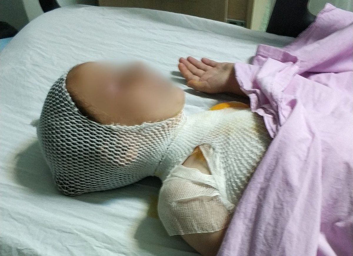 Üzerine Süt Tenceresi Devrilen Çocuk Hastanelik Oldu