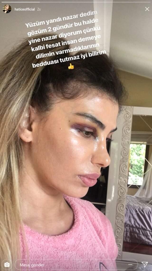 Şarkıcı Hatice, Gözü Morarmış Paylaşımıyla Takipçilerini Korkuttu